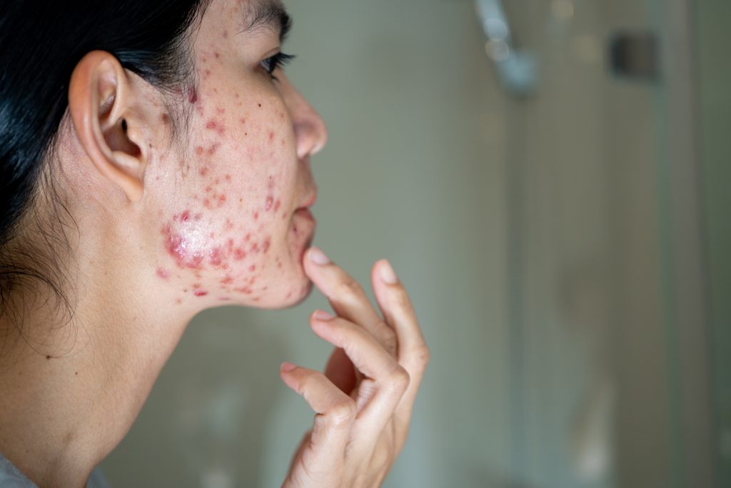 For Acne Sufferers in Thailand｜A Guide to Cosmetic Medicine When Over-the-Counter Medicines Don't Cure the Problem