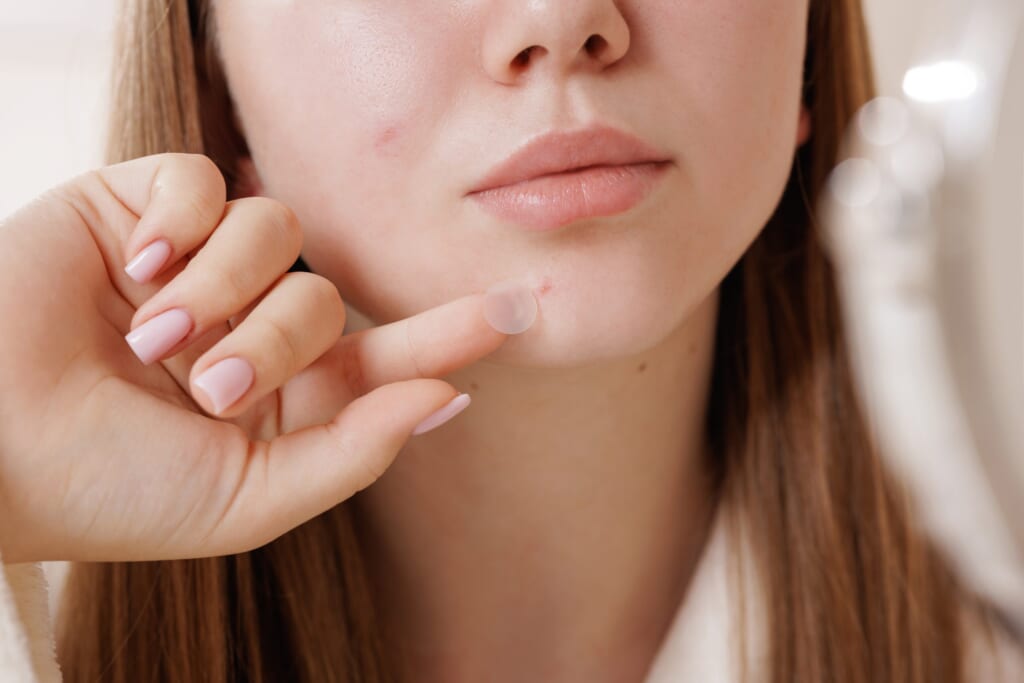 タイでニキビに悩むあなたへ｜市販薬で治らない時の美容医療ガイド