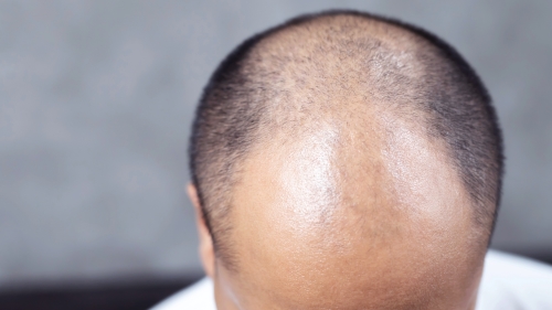 Type of AGA ③: U-shaped Pattern