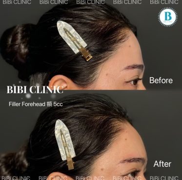 Hyaluronic acid injection (forehead 5cc)