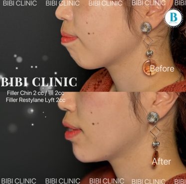 Filler for chin (2cc)