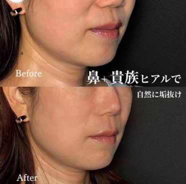 Neauvia Intense 鼻 1cc, Restylane Lyft ほうれい線 各0.5cc