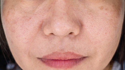 ADM（後天性真皮メラノサイトーシス）