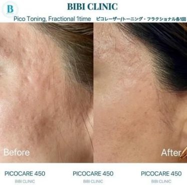 ピコレーザー（トーニング・フラクショナルモード）