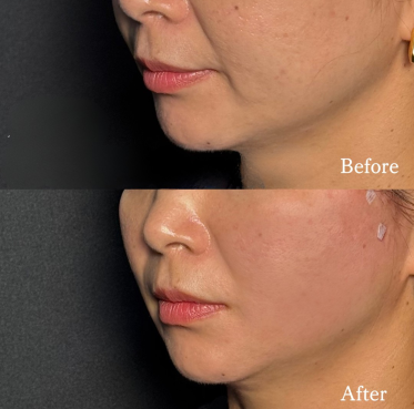 糸リフト／ビアンカリフト（各1本）テスリフト（各2本）