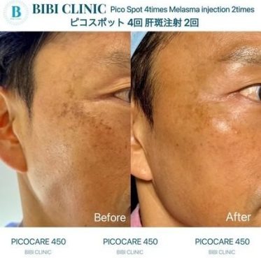 ピコレーザー（スポットモード）＋肝斑注射