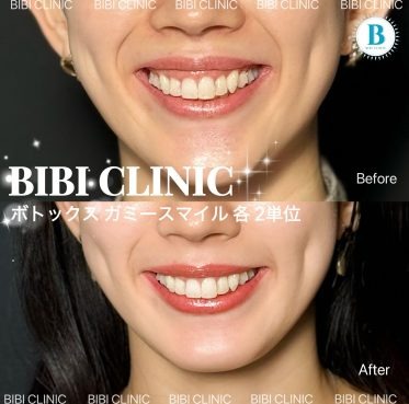 ボトックス ガミースマイル