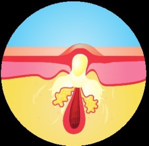 毛穴に詰まった皮脂に雑菌や細菌が繁殖、炎症を起こす