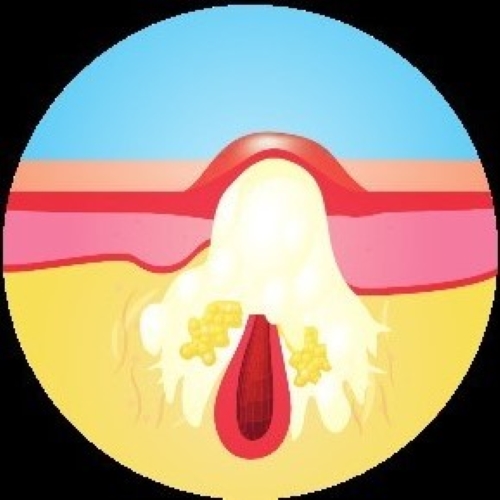 炎症が悪化しうみがたまる