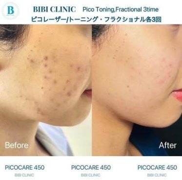 ピコレーザー（トーニング・フラクショナルモード）