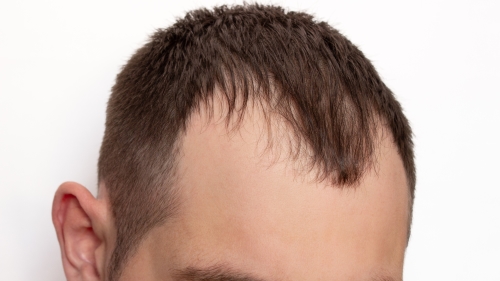 Type of AGA ①: M-shaped Pattern