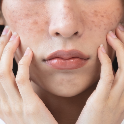 シミ・そばかす