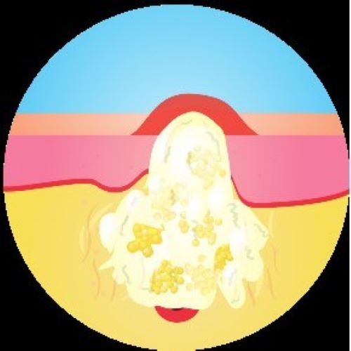  ニキビが治癒し跡として残る