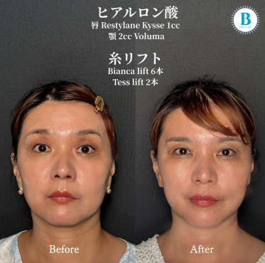 糸リフト／ビアンカリフト（各3本）テスリフト（各1本）