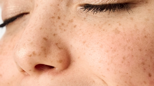 シミやそばかす