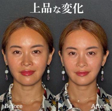 Neauvia Intense 鼻1cc, Restylane Lyft 頬 1cc