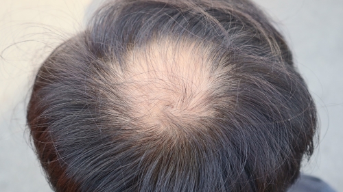 Type of AGA ②: O-shaped Pattern