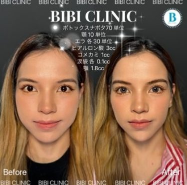 Filler for temple, dolly eyes, and chin