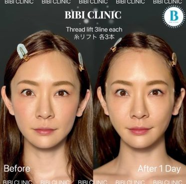 糸リフト／ビアンカリフト（各3本）