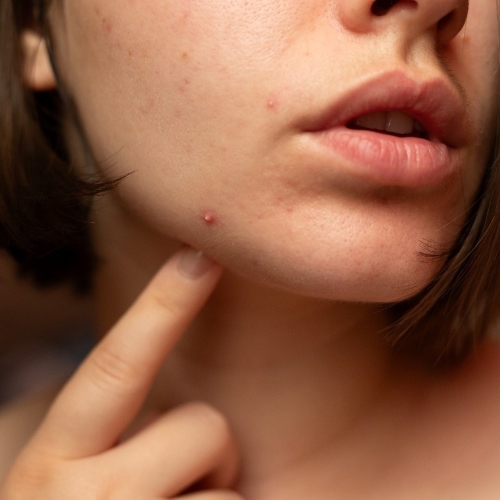 ニキビ・ニキビ跡