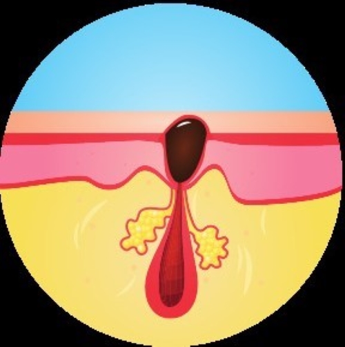 毛穴に皮脂がたまる