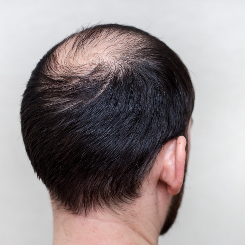 Causes of Hair Loss Are Due to Internal and External Factors