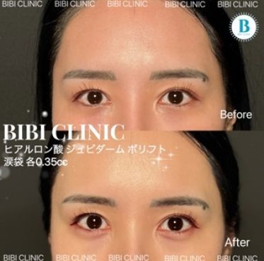 Filler for dolly eyes (0.35cc)