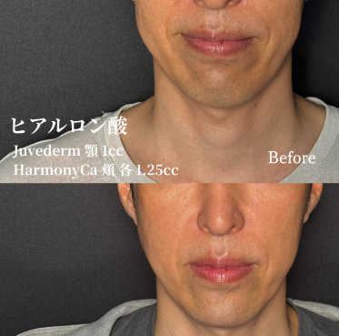 Hyaluronic acid injection (Juvederm chin 1cc, HArmonyCa cheek 1.25cc each)