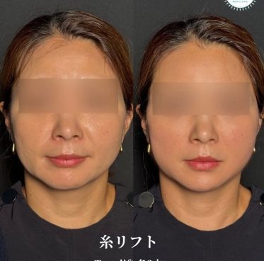 糸リフト／ビアンカリフト（各3本）テスリフト（各1本）