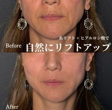 糸リフト／ビアンカリフト（各5本）