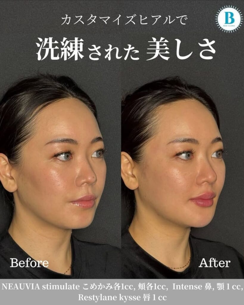 Hyaluronic acid injection (1cc each temple, 1cc each cheek, 1cc each lip)