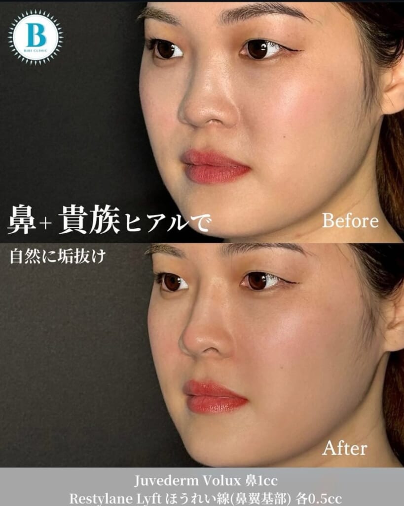 Hyaluronic acid injection (nose 1cc, lips 1cc)