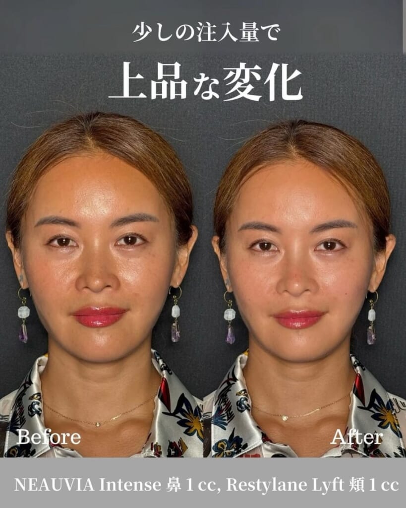 Filler for nose and cheeks