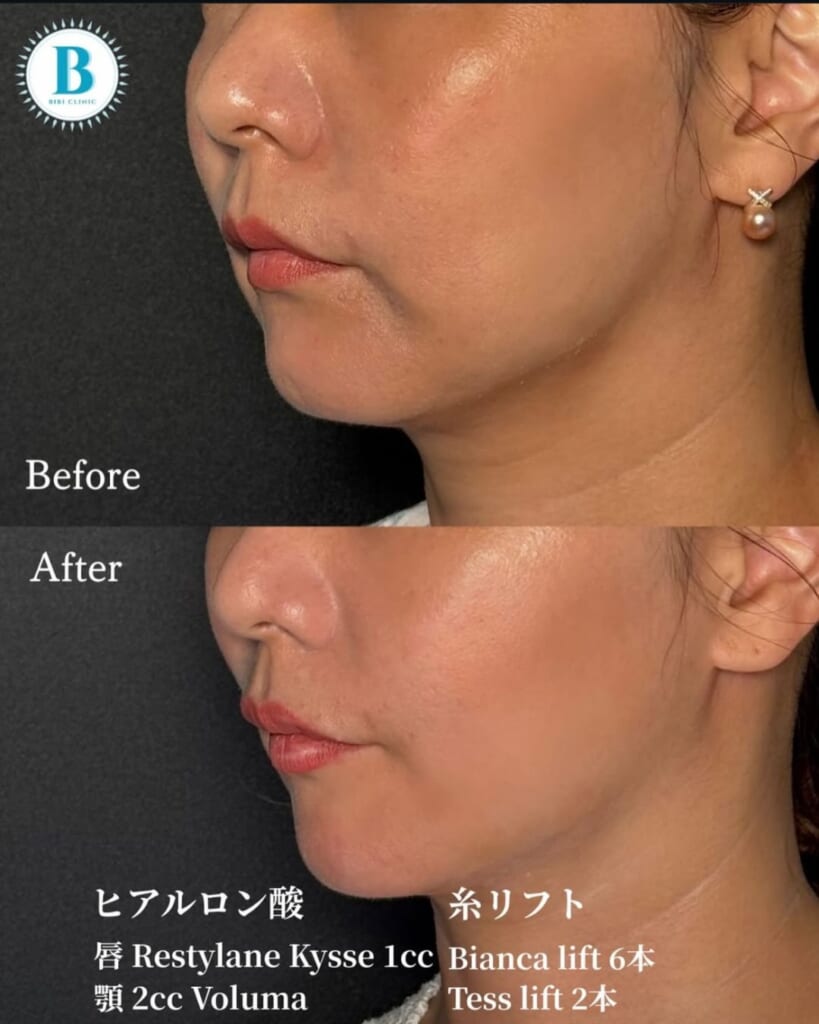 Filler for chin and lips