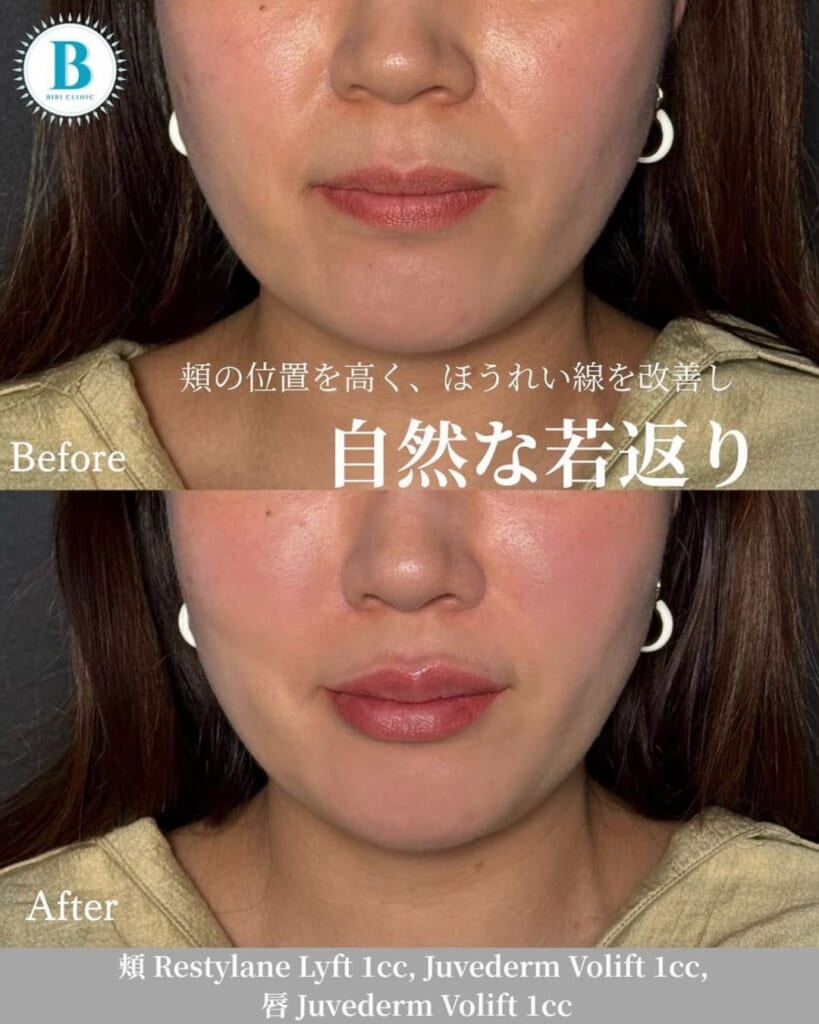Hyaluronic acid injection (cheek 2cc, lip 1cc)