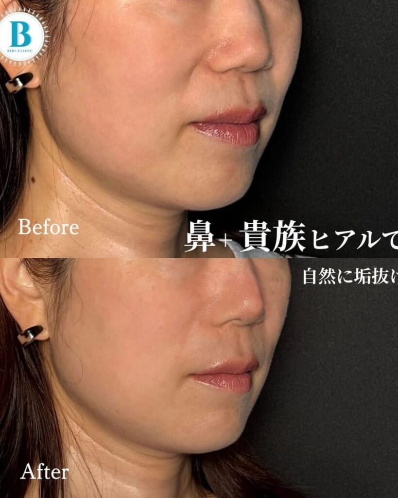 Hyaluronic acid injection (1cc for laugh lines, 1cc for nose)
