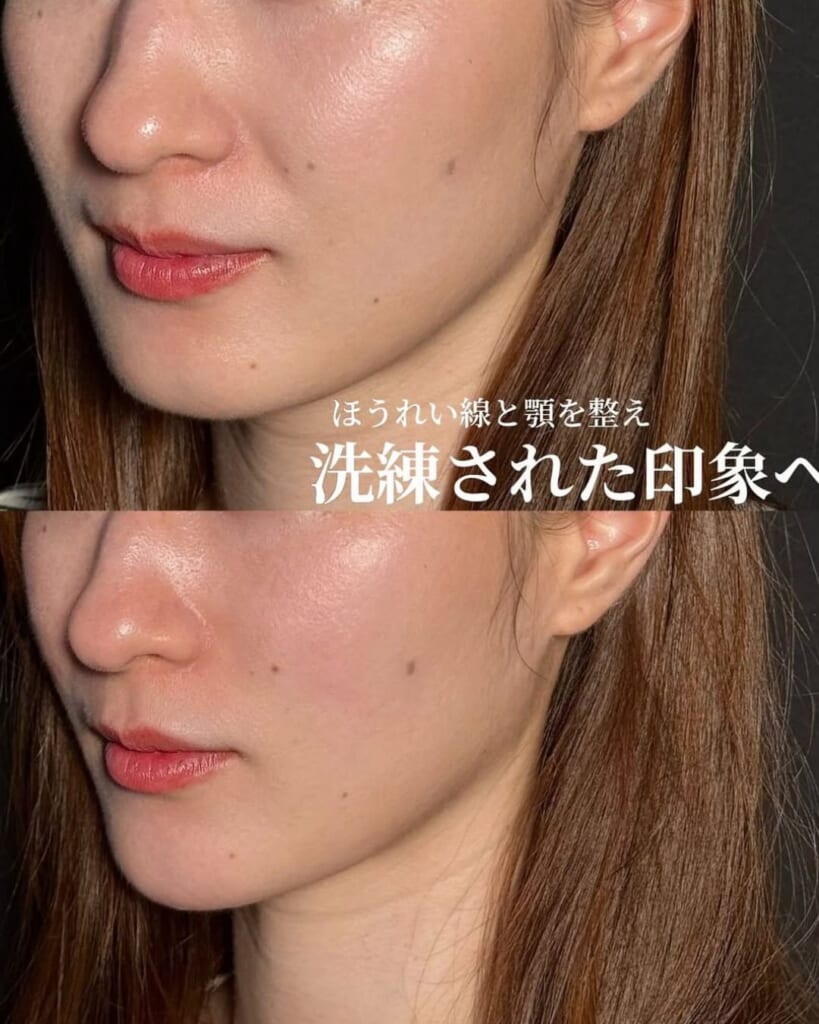 Hyaluronic acid injection (laugh lines 1cc, chin 1cc, cheeks 1cc)