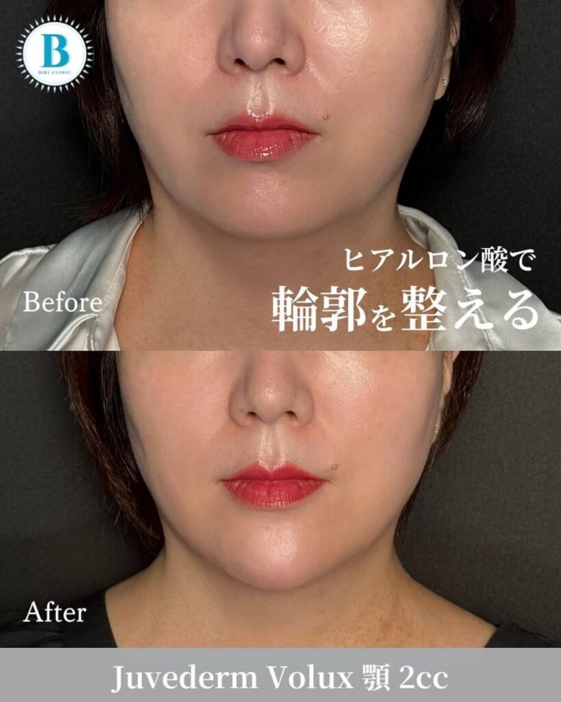 Hyaluronic acid injection (chin 2cc)