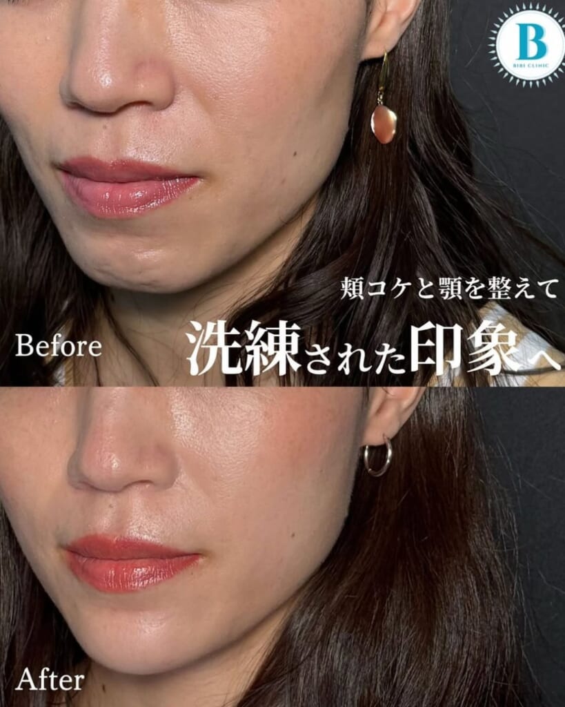Hyaluronic acid injection (cheek 2cc, chin 1cc)