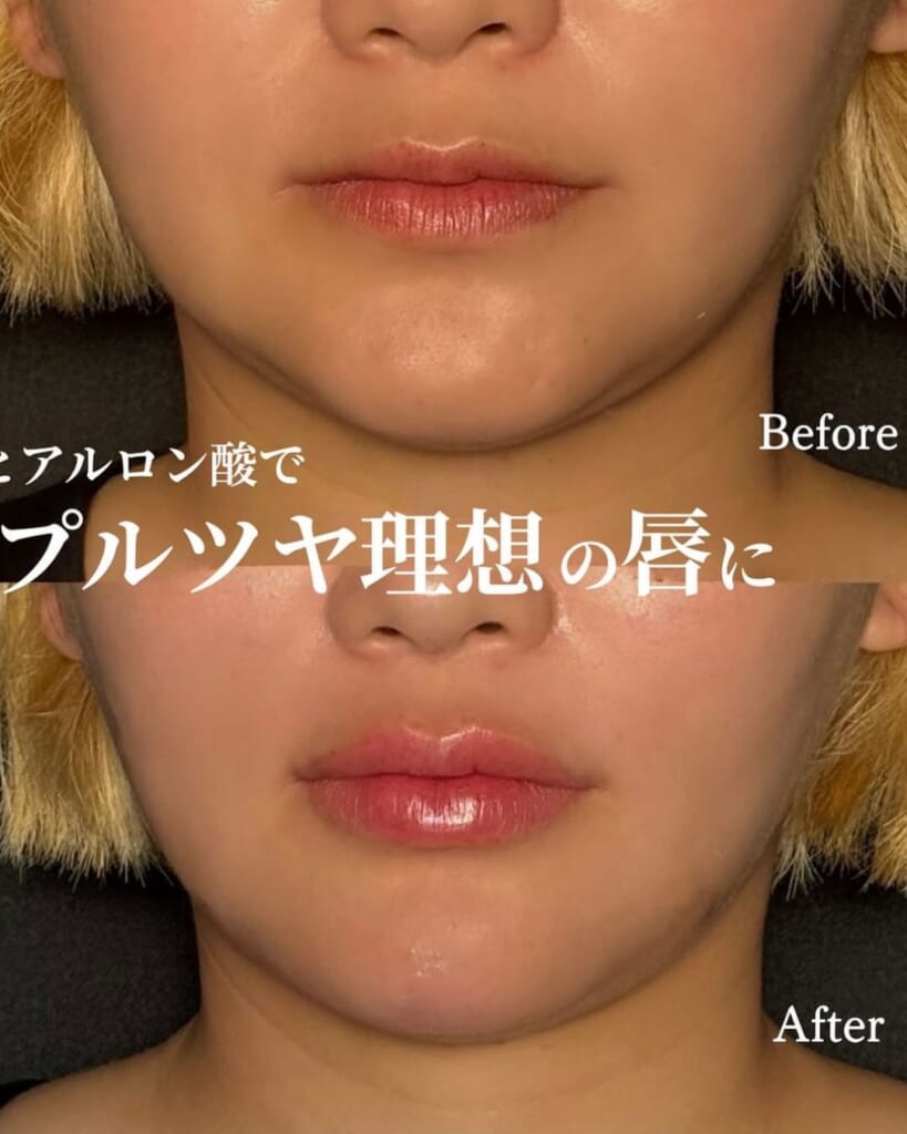 Hyaluronic acid injection (1cc for lips)