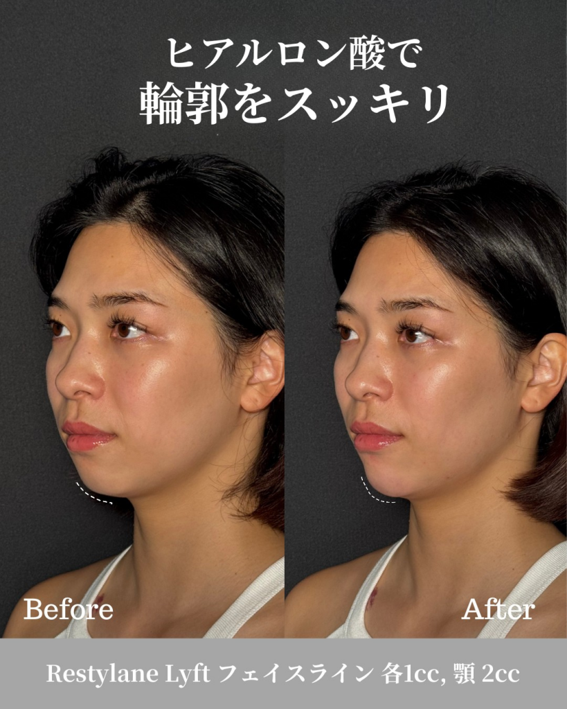 ヒアルロン酸注射(フェイスライン 各1cc, 顎 2cc)