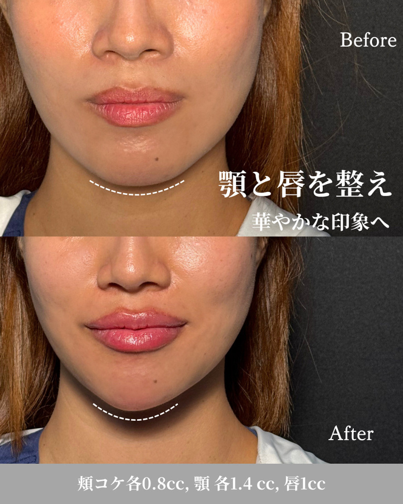 Hyaluronic acid injection (cheek moss 0.8cc each, chin 1.4cc, lip 1cc)