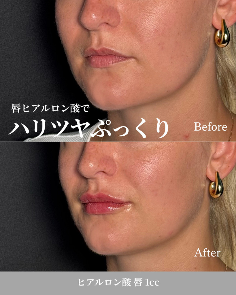 Hyaluronic acid injection (lips, 1cc)