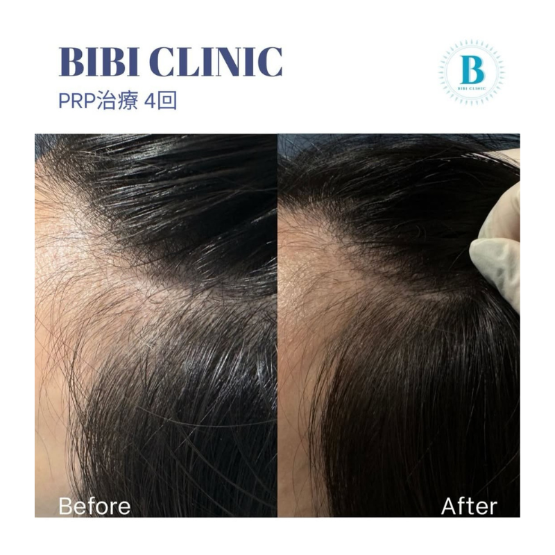薄毛　バンコクでAGA治療を受けるなら？自然に“バレずに育てる”発毛アプローチ｜Bibi Clinic｜ビビクリニック｜タイ・バンコクの美容クリニック