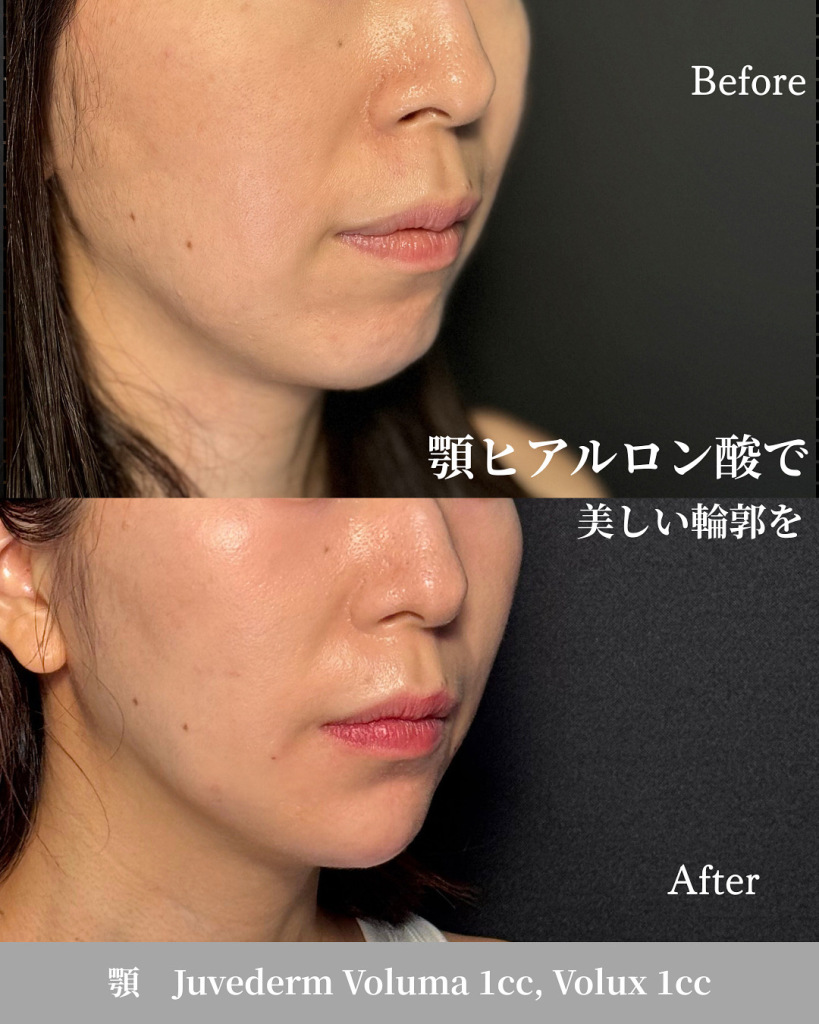 Hyaluronic acid injection (chin 2cc)