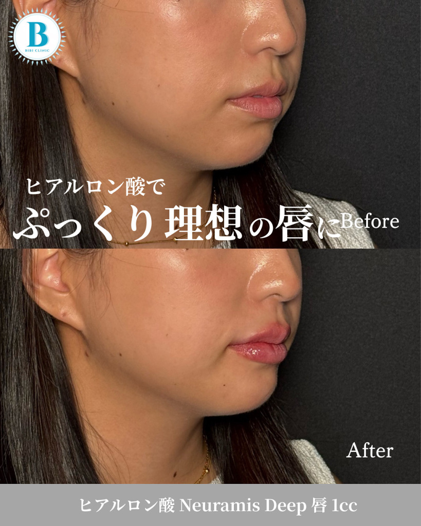 ヒアルロン酸注射(唇 1cc)