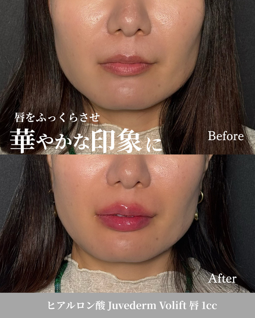 Hyaluronic acid injection (lips, 1cc)