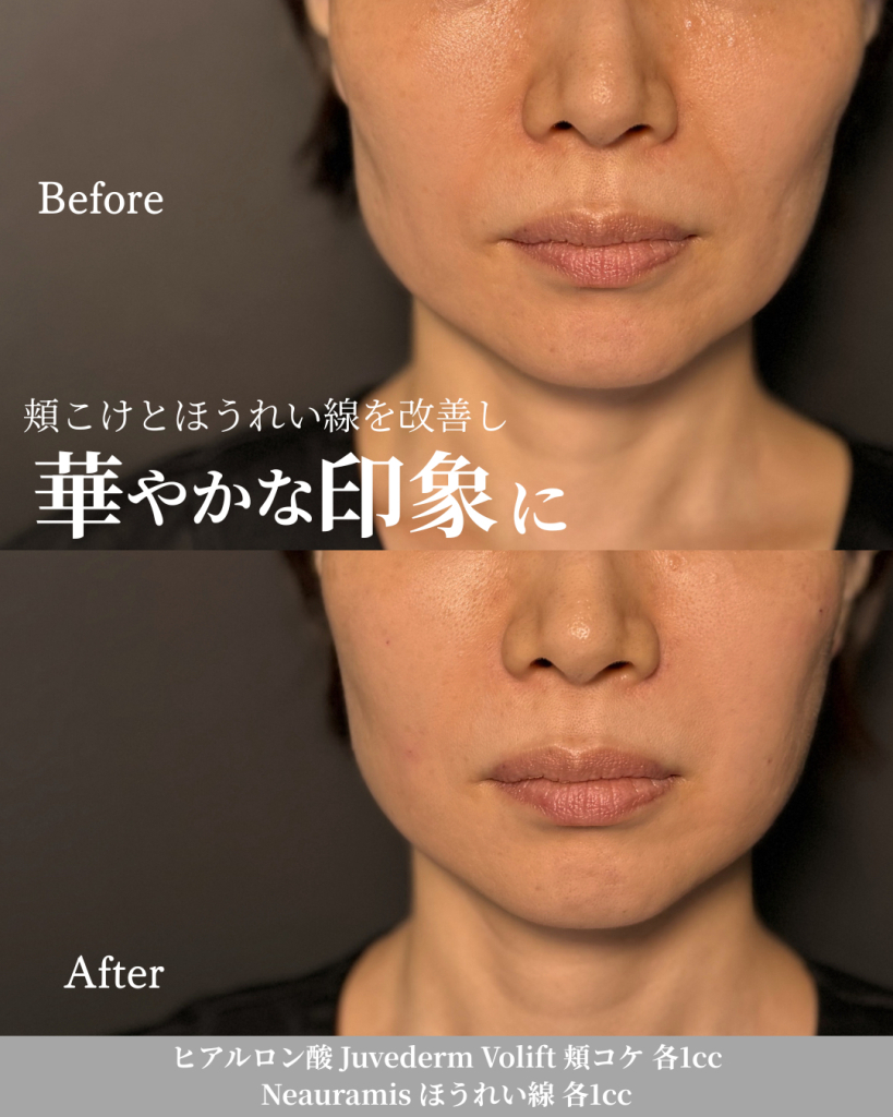 ヒアルロン酸注射(頬コケ 各1cc, ほうれい線 各1cc)