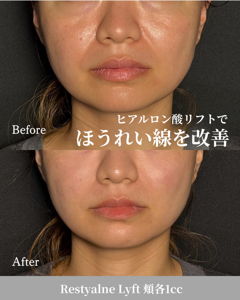 Hyaluronic acid injection (cheek 1cc)