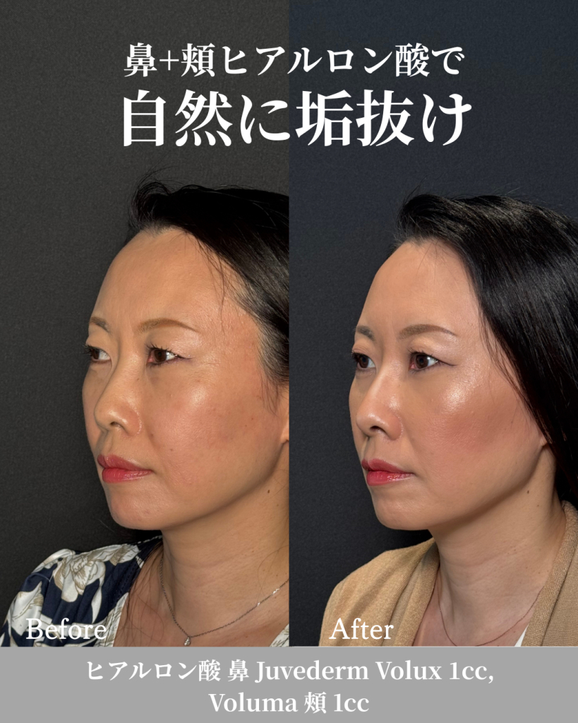 ヒアルロン酸注射(鼻 1cc, 頬 1cc)